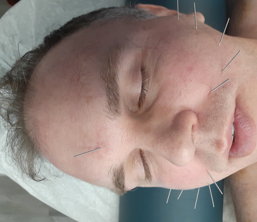 facial acupuncture