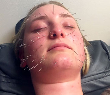 facial acupuncture